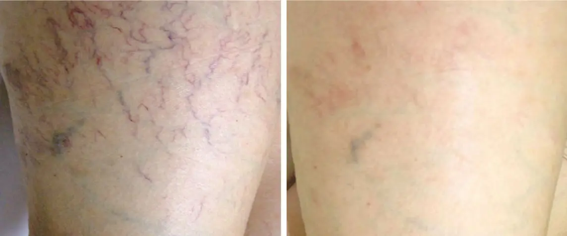 Eliminación de Várices 1