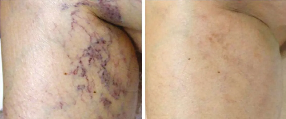 Eliminación de Várices 1