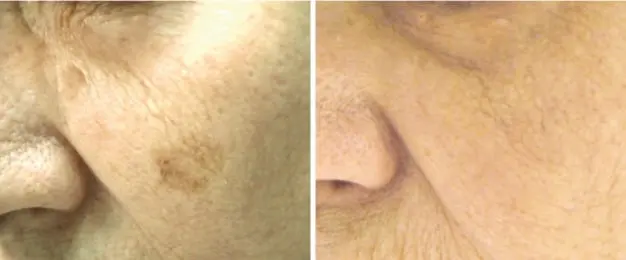 Lesiones pigmentadas, ejemplo 1