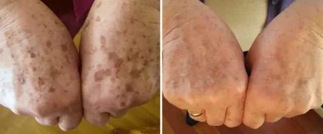 Lesiones pigmentadas, ejemplo 2