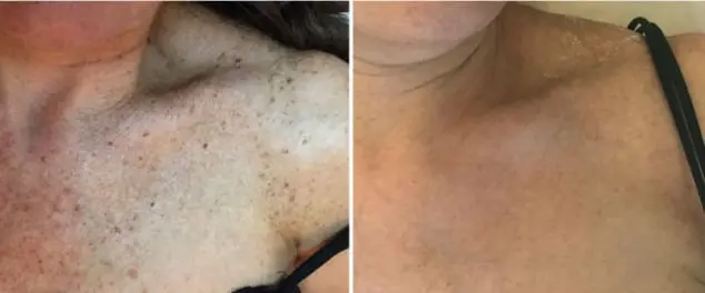 Lesiones pigmentadas, ejemplo 3