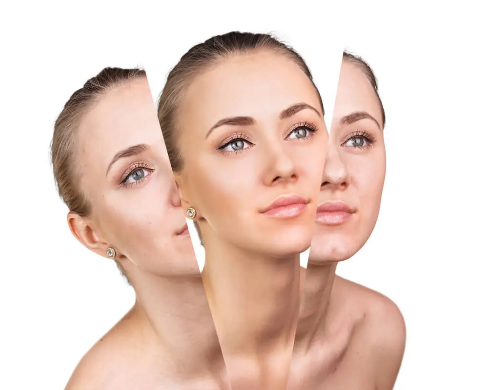 Peeling Químico - Dr. Andrés Cordero