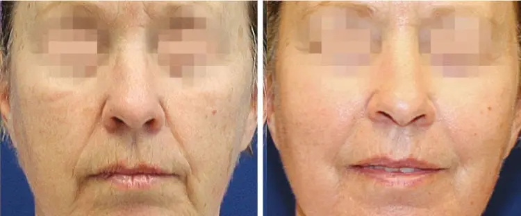 Rejuvenecimiento de la piel - ejemplo 1