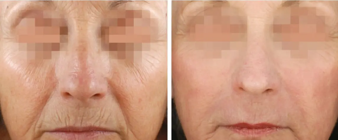 Rejuvenecimiento de la piel - ejemplo 2