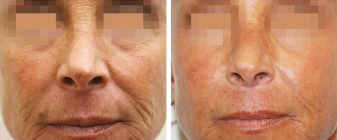 Rejuvenecimiento de la piel - ejemplo 3